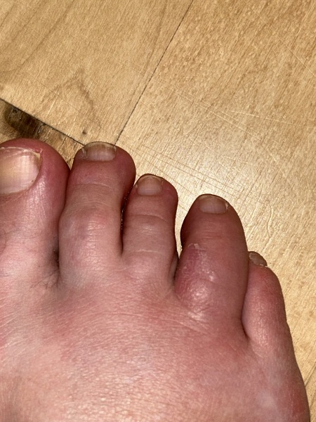 A thread for those with psoriatic arthritis?