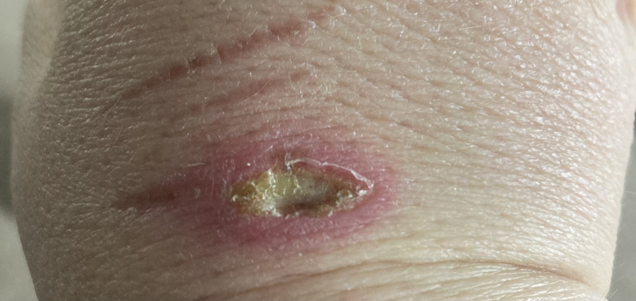 Does this burn look ok?