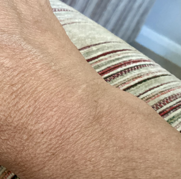 Lump on wrist