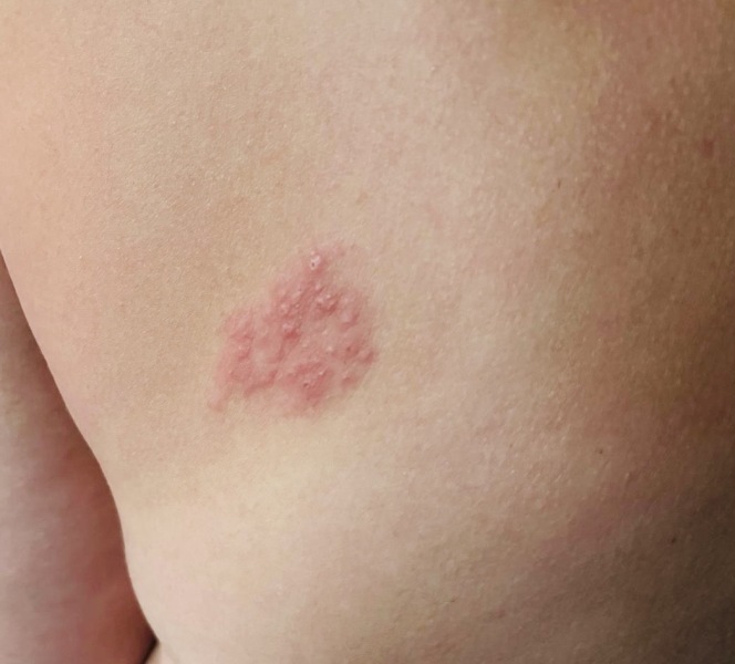 Weird rash / hives / other?