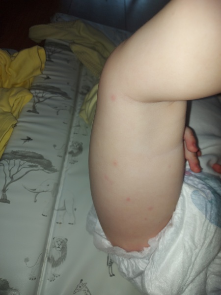 Could this be chicken pox