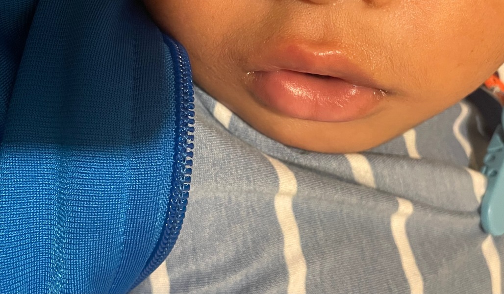 Red patch on baby’s lip