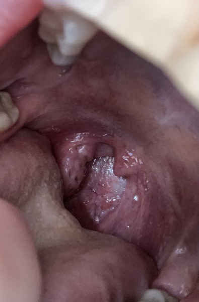 1 swollen tonsil