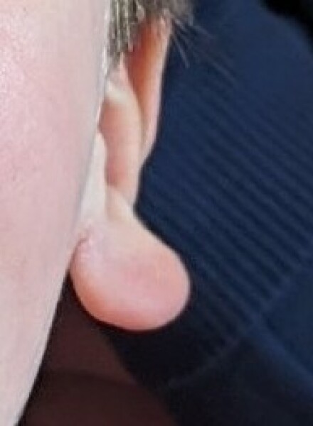 I think my son has slightly weird ears? What's this called?