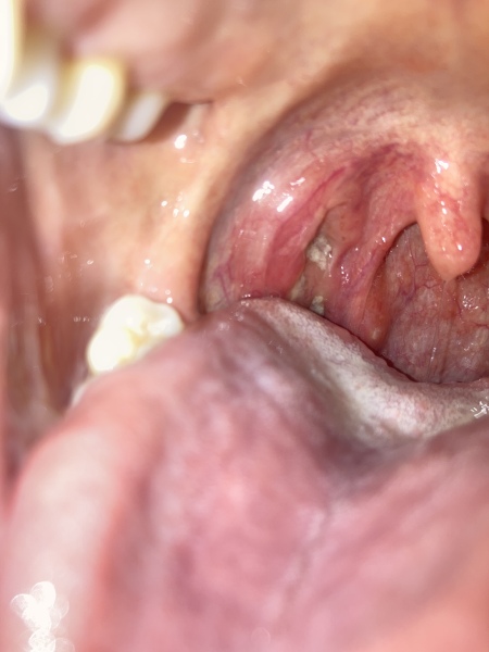 Would you go to Gp with tonsils like this?  *gross pic*
