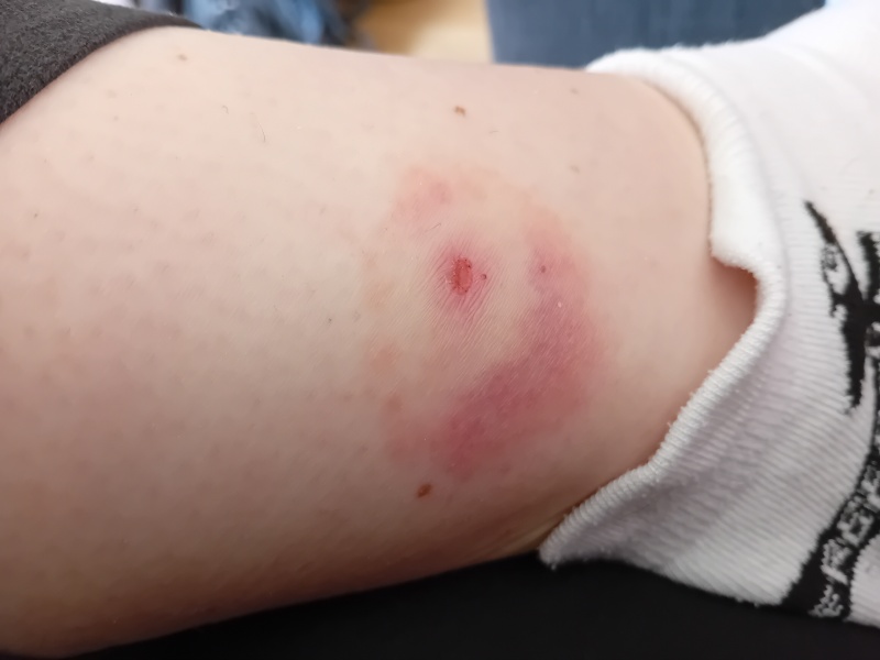 Bite