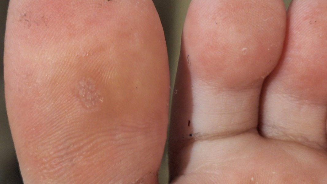 Verruca, any opinions on if this is gone yet?