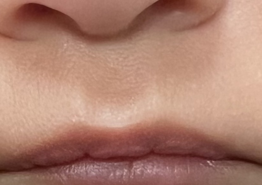 Smooth philtrum ??