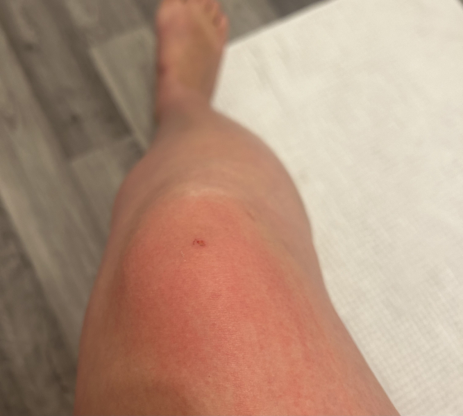 Do I need A&E for this?