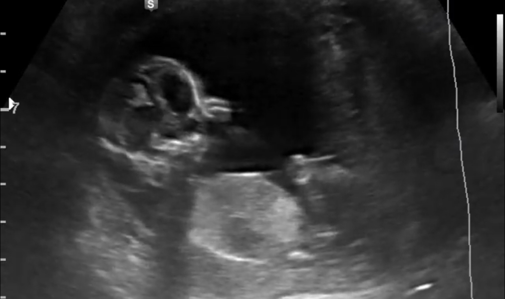 Nub / Gender - Ultrasound Tech wouldn’t commit! Opinions?