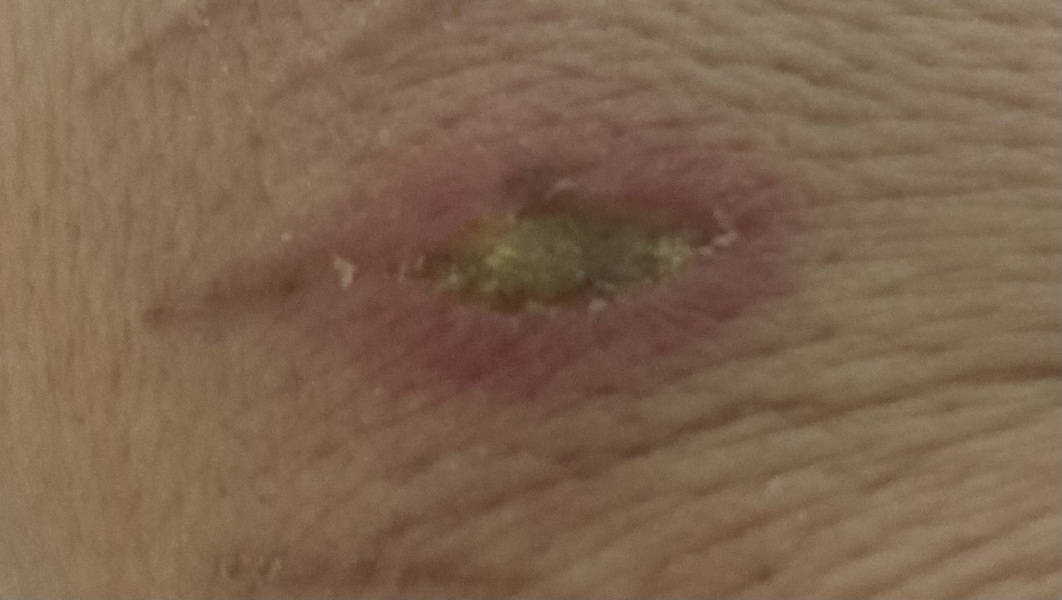 Does this burn look ok?