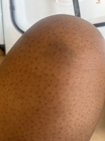 Bruise on leg after workout