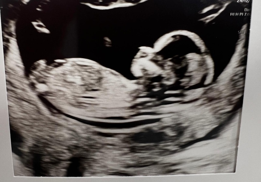 Nub theory - boy or girl? 12 wks 2 days