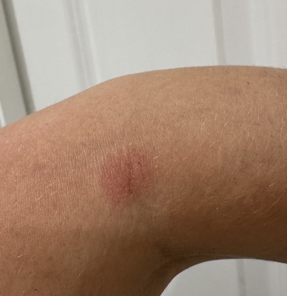 What is this odd thing on my arm? Eczema (never had it before!), something else?