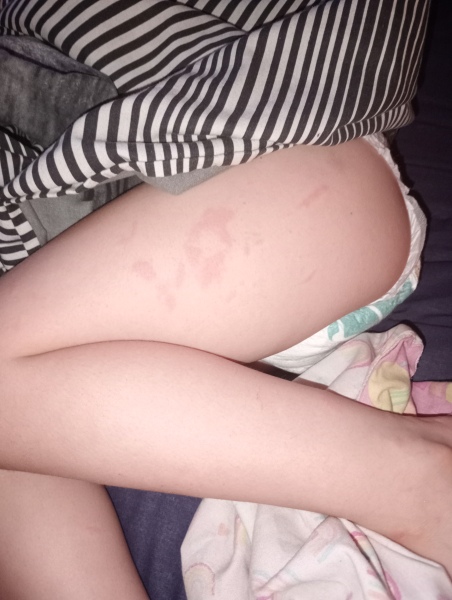 Circular rash