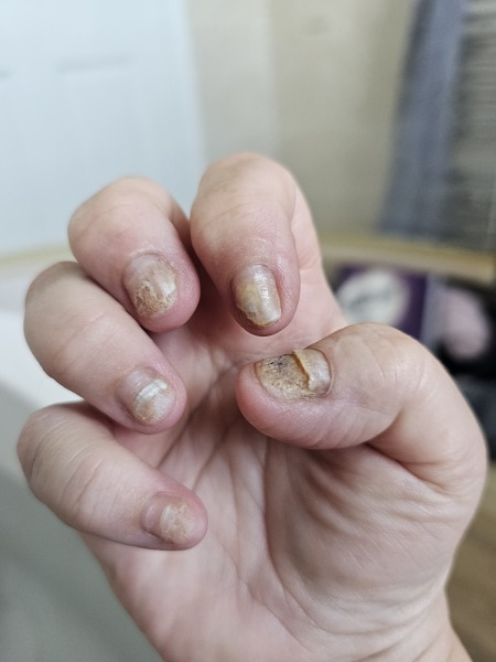 Sudden allergy to BIAB nails :(