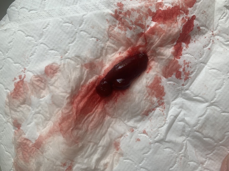 Miscarriage or period clot