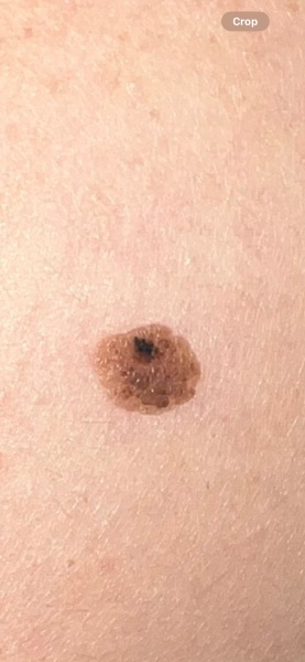 Melanoma?