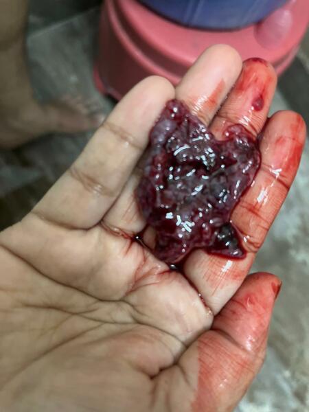 Big blood clots? Pic attached * tw for blood