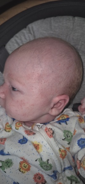 Does this look like baby acne or an allergy?