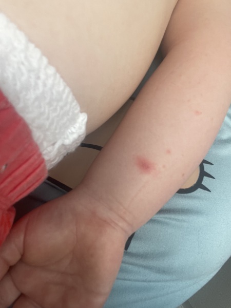 HFMD or chickenpox?