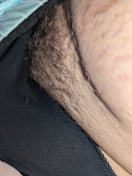 C-section incision has lumpy bits sticking out?