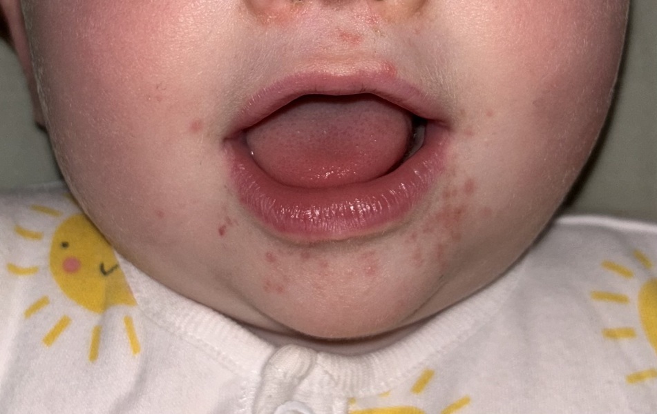 Spots around mouth