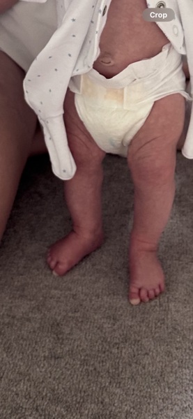 Clubbed foot? - questioning my own GP.