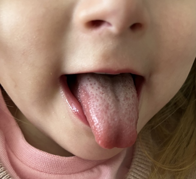 Strawberry Tongue?