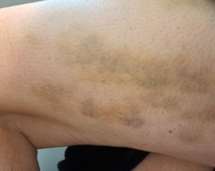 Huge bruises on legs for 3 weeks... what's going on?!