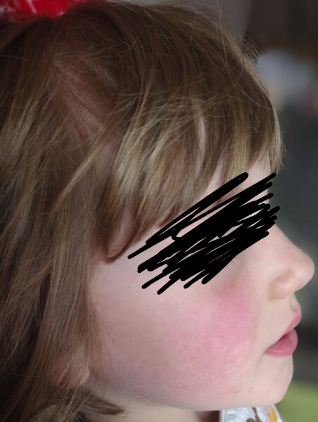 Please tell me this is just sunburn not slapped cheek