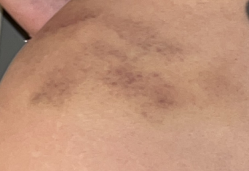 So sore after massage, is this normal?