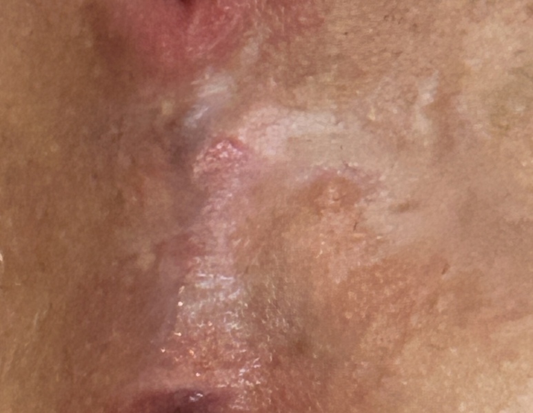 Third degree tears and episiotomy TW picture plus rectocele issue