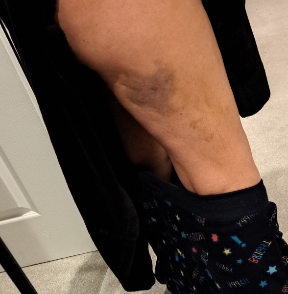 Huge bruises on legs for 3 weeks... what's going on?!