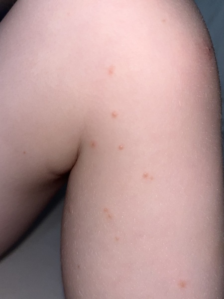 Potential chicken pox?