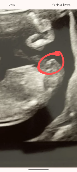 12 week scan but can’t see nub