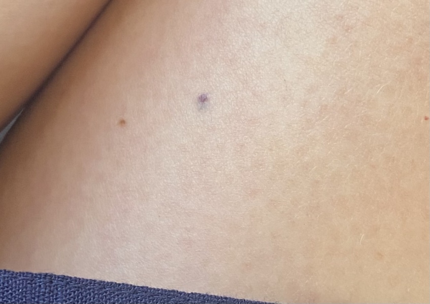 Blood blister?