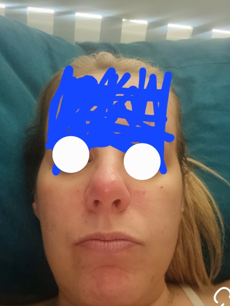 Spots on nose