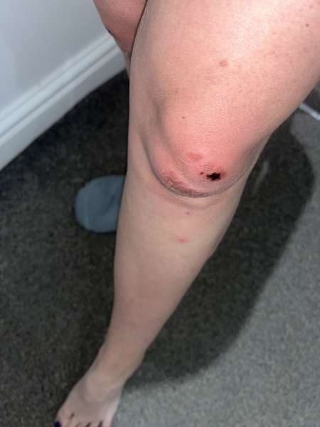 GROSS PHOTO WARNING - Frozen peas or A&E?