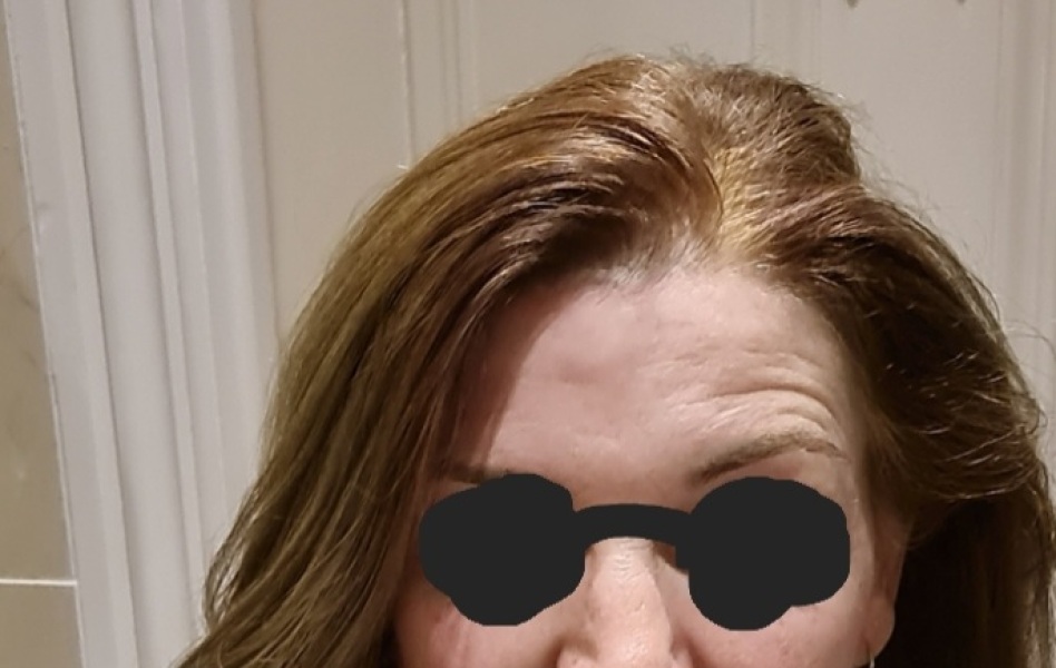 Newly allergic to hair colour, after 25 years!
