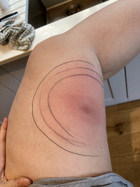 My skin massively overreacts to mosquito bites