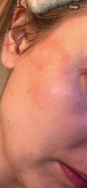 Eczema/Allergies/Diet/HRT/getting older ?