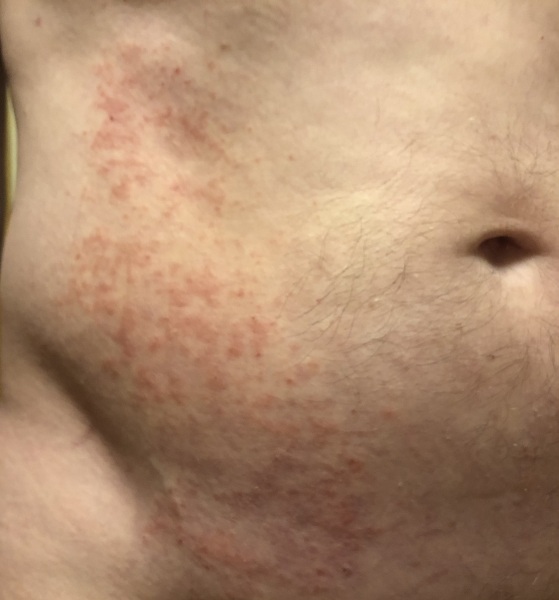 AIBU to ask what this rash on the torso is? Photos