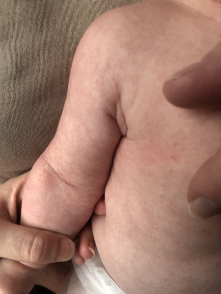 Cows milk allergy or heat rash?