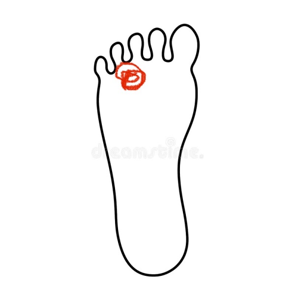 Strange foot feeling - connected to bunion?