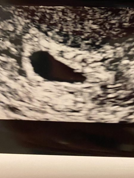 BFP after recent loss