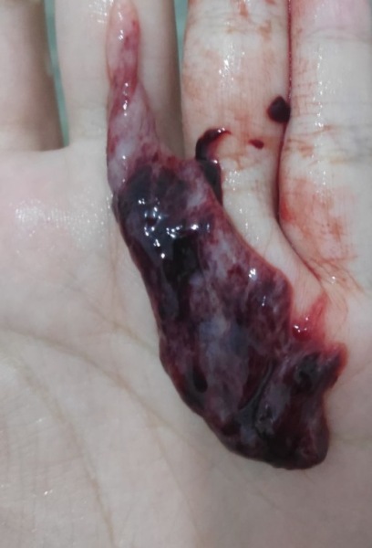 TRIGGER WARNING MISCARRIAGE PHOTO