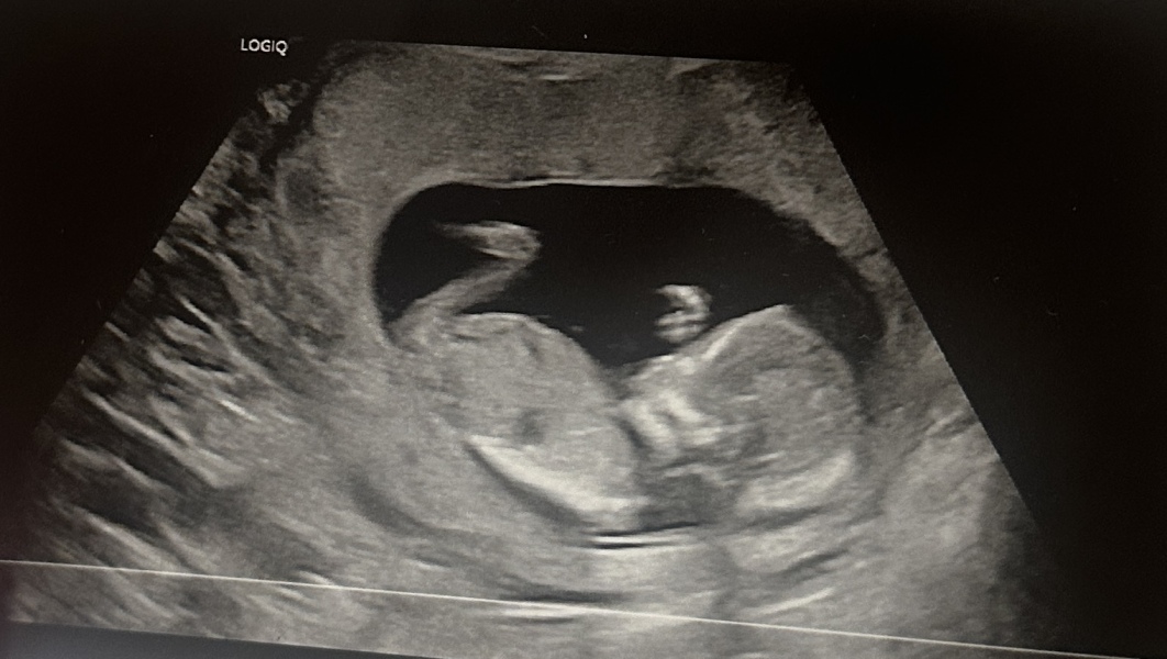 Any guesses, boy or girl? 12 week scan