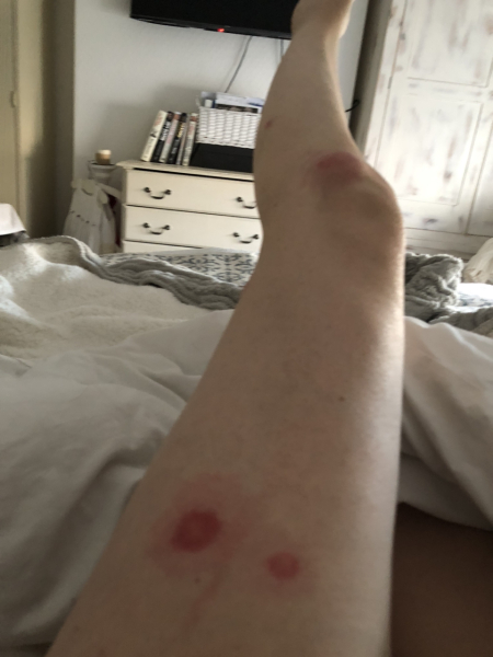 Horse fly bites? Photo
