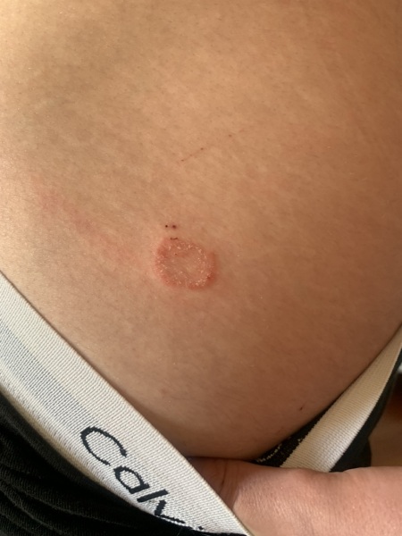 Ringworm?